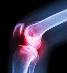 Revision (Redo) Joint Replacements Of The Hip, Knee, and Shoulder