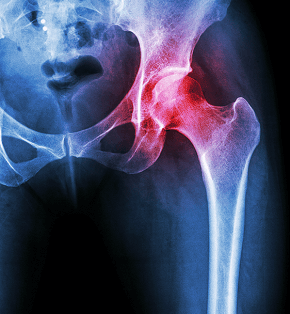 Joint Replacements Of The Hip, Knee, And Shoulder