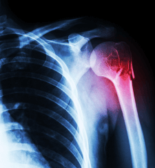 Arthroscopies Of The Knee And Shoulder