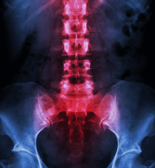 Non-Surgical Management Of The Spine